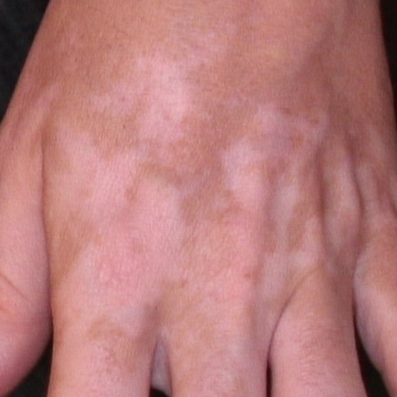 Combinação de carboxiterapia com ultravioleta B de banda estreita no tratamento de áreas recalcitrantes de vitiligo: um ensaio clínico randomizado