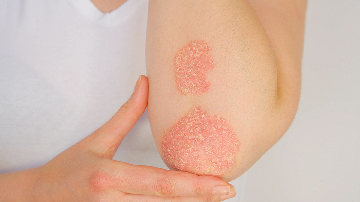 830-nm and 633-nm light-emitting diode phototherapy for psoriasis