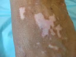 A terapia NB-UVB é eficaz para aliviar o estresse psicológico e melhorar a qualidade de vida dos pacientes com vitiligo.