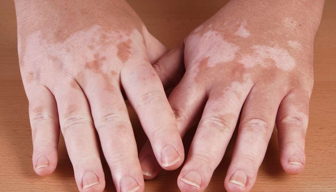 Os achados desta revisão sistemática e meta-análise sugerem que a fototerapia UV é um tratamento seguro para o vitiligo sem risco significativo de câncer de pele.